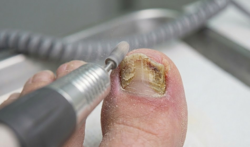 Deforme tırnak restorasyonu