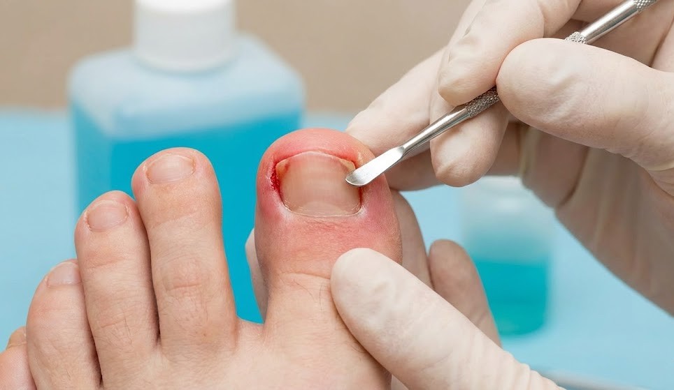 Isparta Tırnak Batması Tedavisi