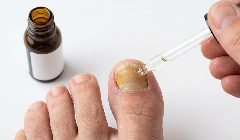 Isparta Tırnak Mantarı Tedavisi