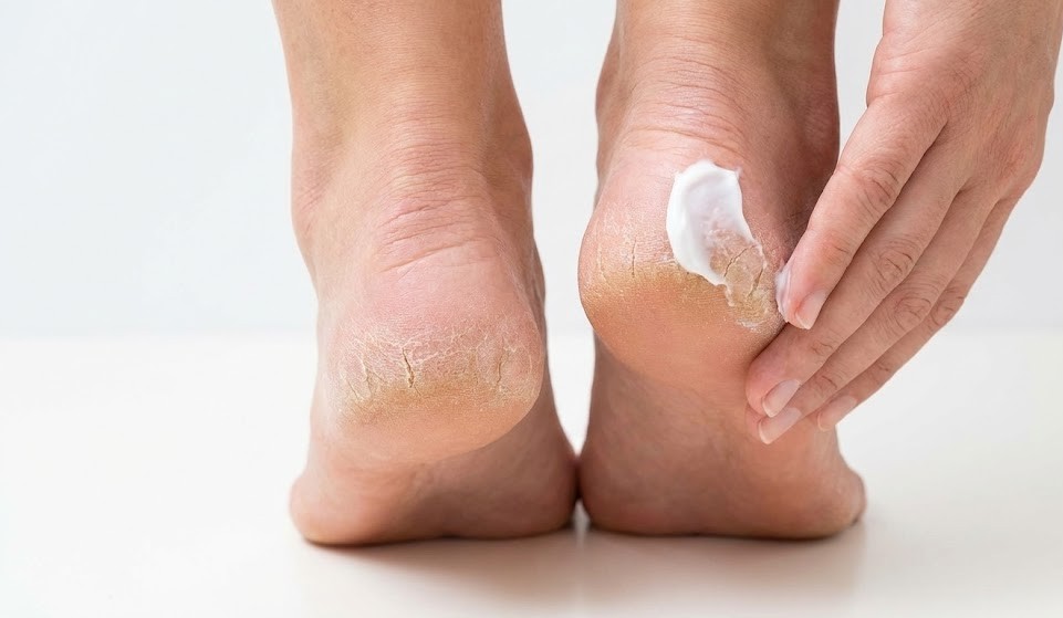 Isparta Topuk Çatlağı Bakımı